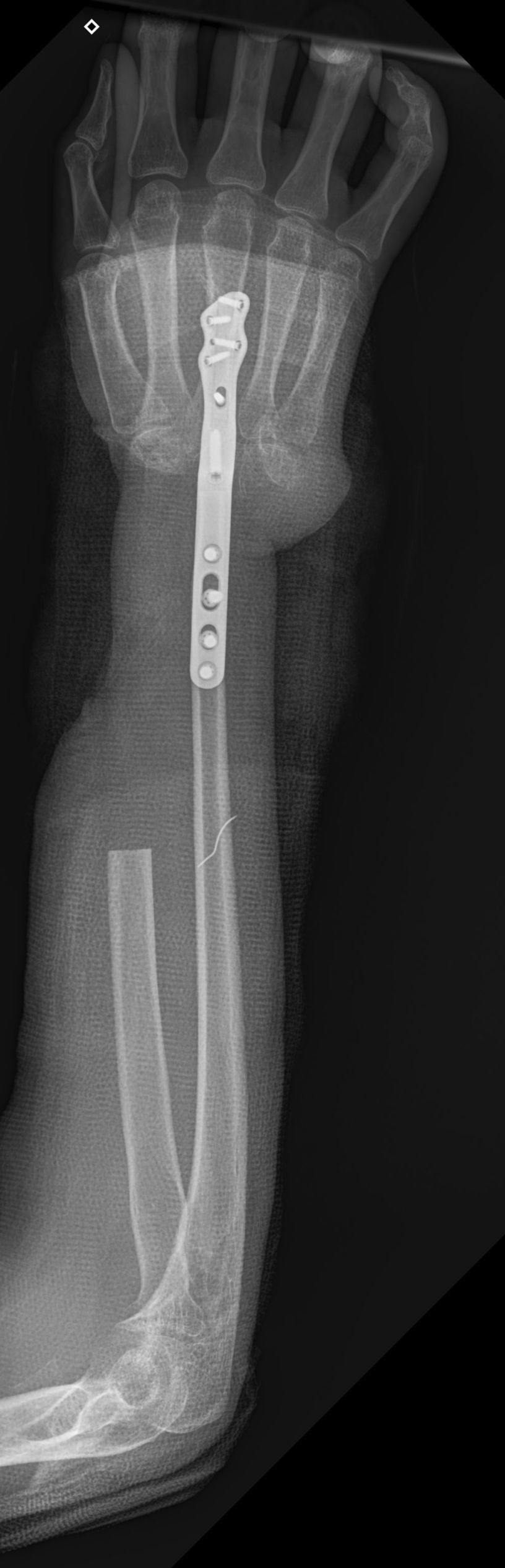 An Arm Saved